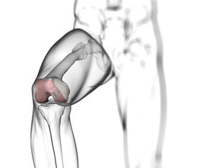 Episurf knee inplants